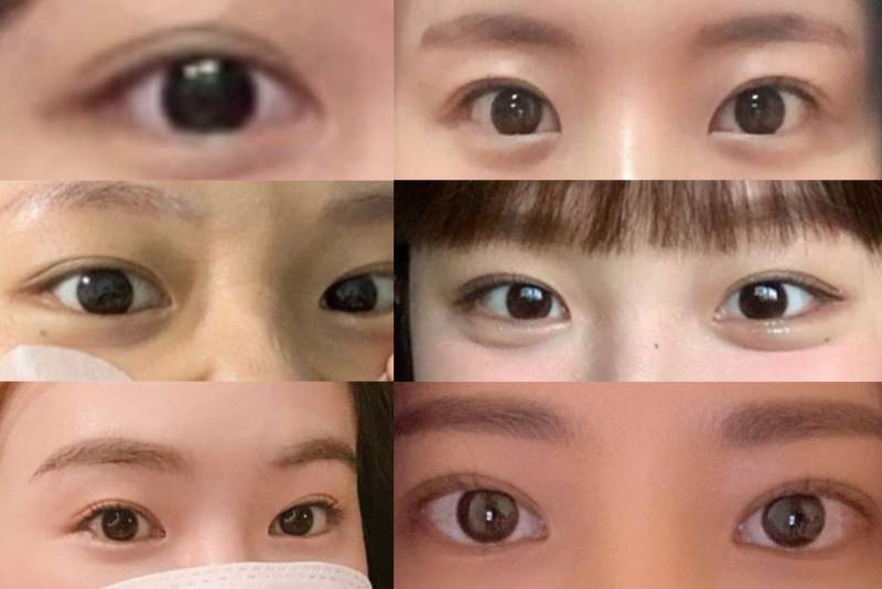 쌍수하러 갈 때 이렇게 사진 들고갈건데 지금 내 눈에 가능한 라인들이야ㅠ? | 인스티즈