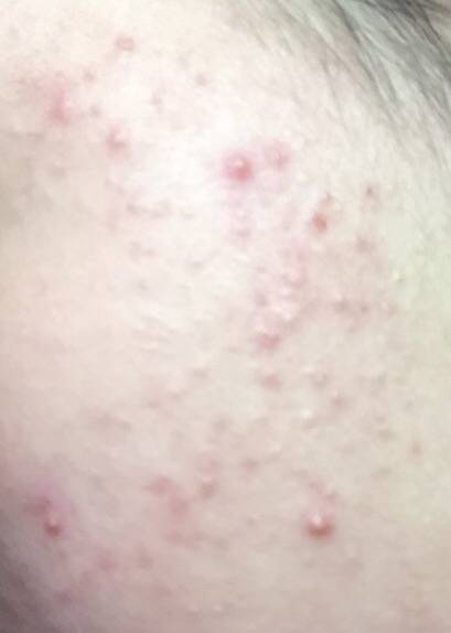 익들아 나 이런 여드름이 한달 넘게 안 사라져.. ㅠㅠ 혐오주의 | 인스티즈