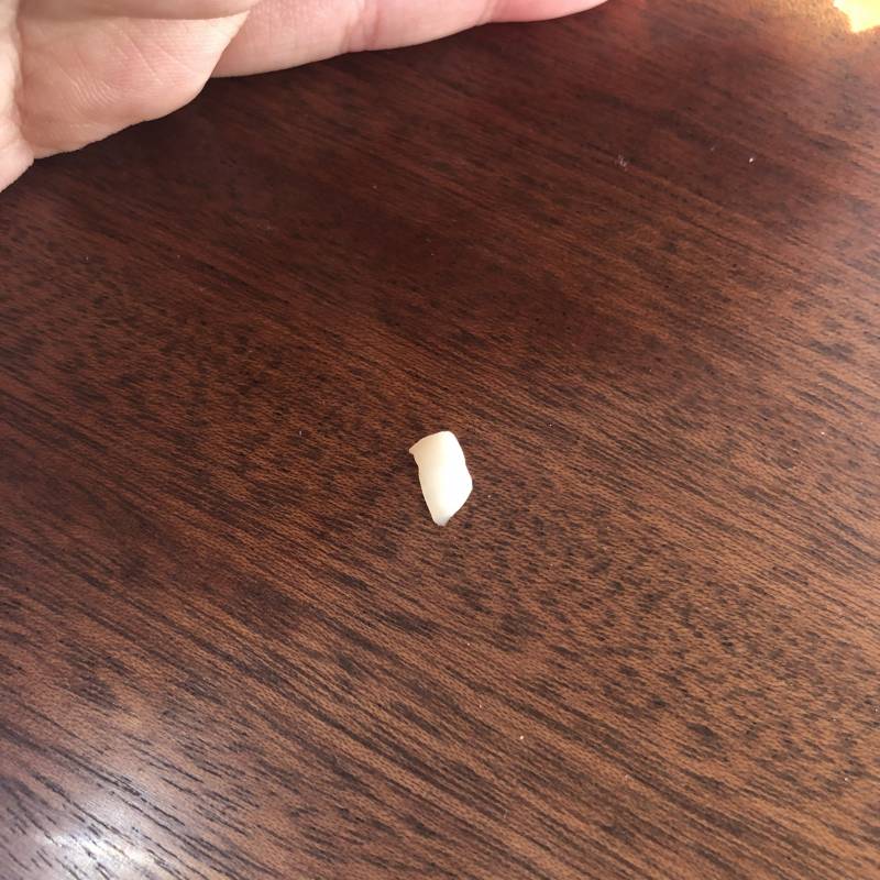 치아 떼운게 떨어졌어ㅠㅠㅠㅠ | 인스티즈