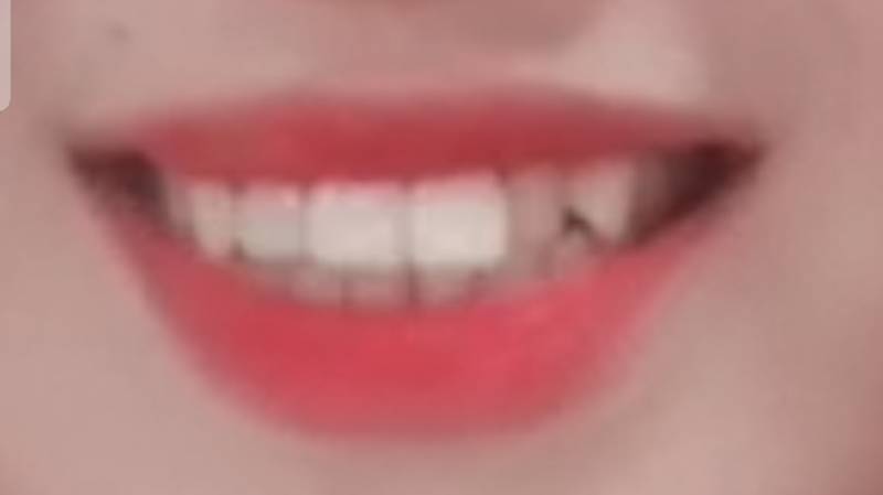 지금 치아 상태 이런데 교정하는게 낫겠지ㅠㅠ?(사진있음) | 인스티즈