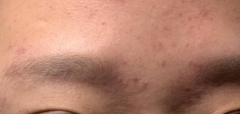 토하면 얼굴에 핏줄 터지는 익 있어?(사진주의) | 인스티즈