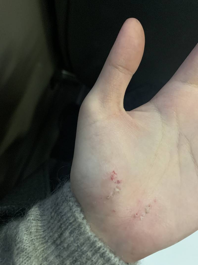 혐오ㅈㅇ) 아니 흙길?에서 넘어졌는데 피부 밑에 흙알갱이 들어간거 같은디 | 인스티즈