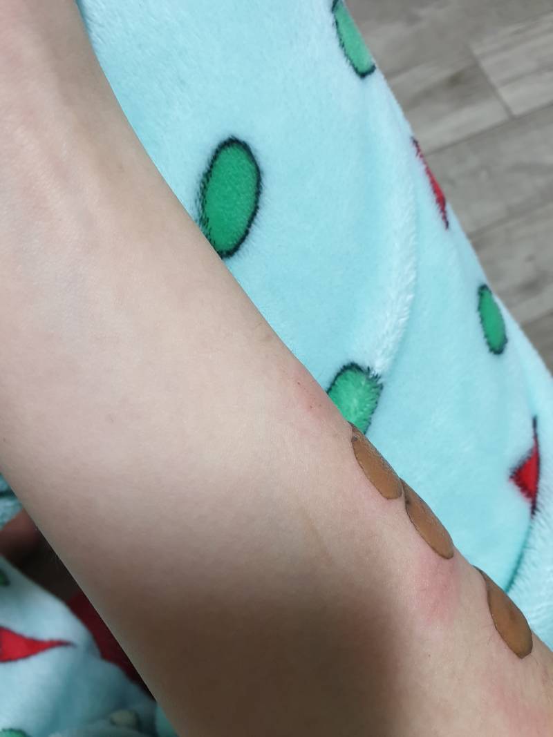 칼에 베인 상처인데 10일이상 지났는데도 이렇게 부어있으면 왜그런거야?ㅠㅠ | 인스티즈