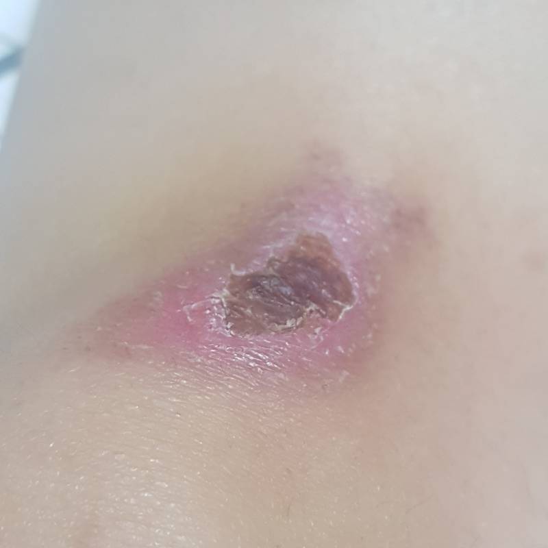 익들 나 딱지 떨어지는 중인데 원래 떼진 부분 피부색깔이 이래...? | 인스티즈