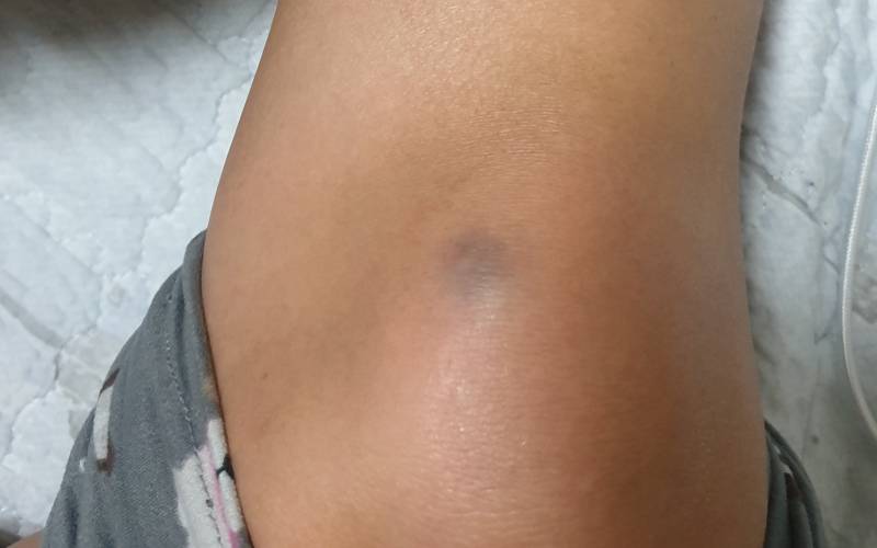 부딛힌적없는데 멍같은게 생겼어 이게뭐지? | 인스티즈