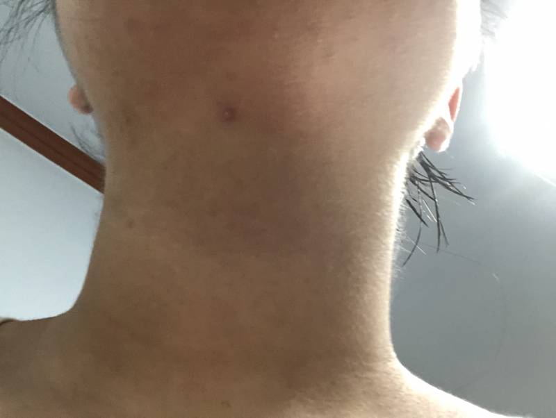 목인가 턱쪽에 여드름났는데 이건 왜난거지..?? | 인스티즈