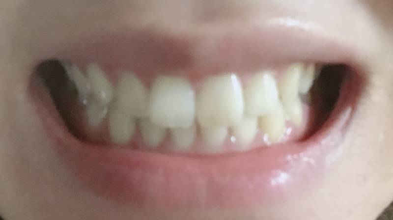 이가 누런거 같아서 태국에서 사왔던 치약? 비슷한걸로 닦아봤는데 | 인스티즈