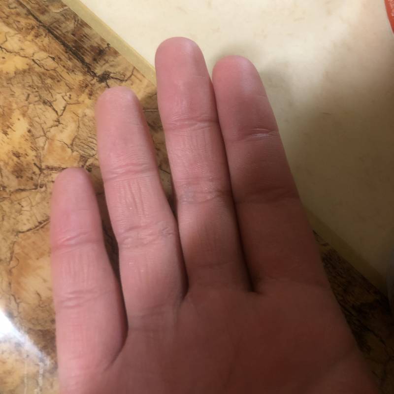 익들아 손 거칠거칠해진거도 피부과 가면 돼??? | 인스티즈