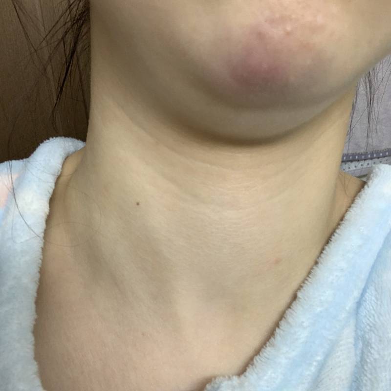 턱이 이렇게 됐는데 어떡해ㅠㅠㅠㅠ 너무 아파.... | 인스티즈