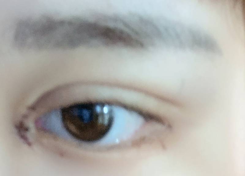 쌍수 3일차 붓기 빠지는 과정 보고 갈래?40(혐오주의) | 인스티즈