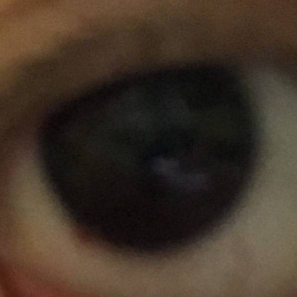 눈에 빨간점?같은게 있는데 40 | 인스티즈