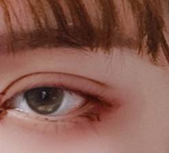 쌍수 3일차 붓기 빠지는 과정 보고 갈래?40(혐오주의) | 인스티즈