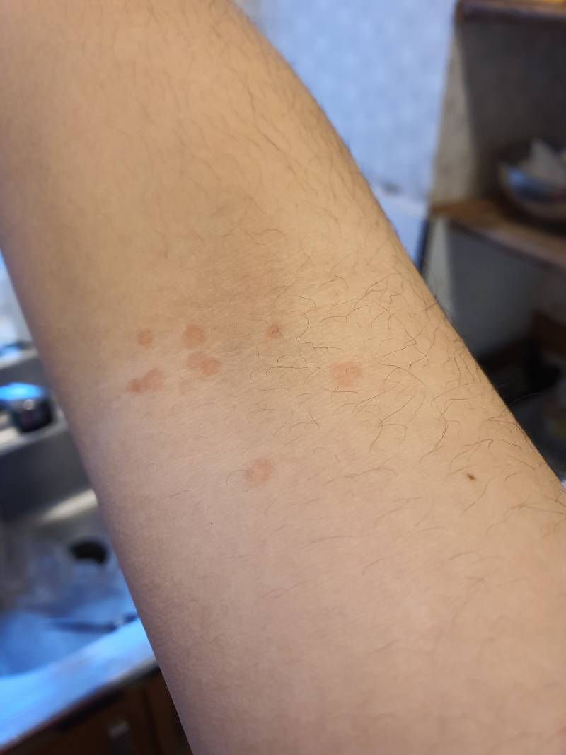 일어났는데 몸에 이상한 흉터가 있어....(혐오주의) | 인스티즈