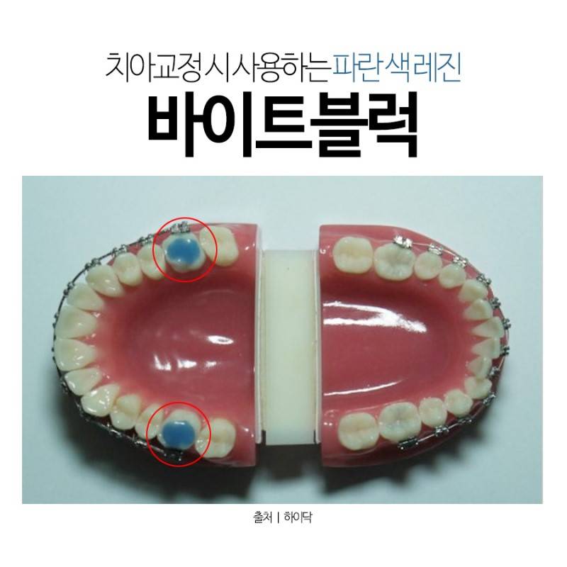 교정익들 중에 이거 붙여본 익? | 인스티즈