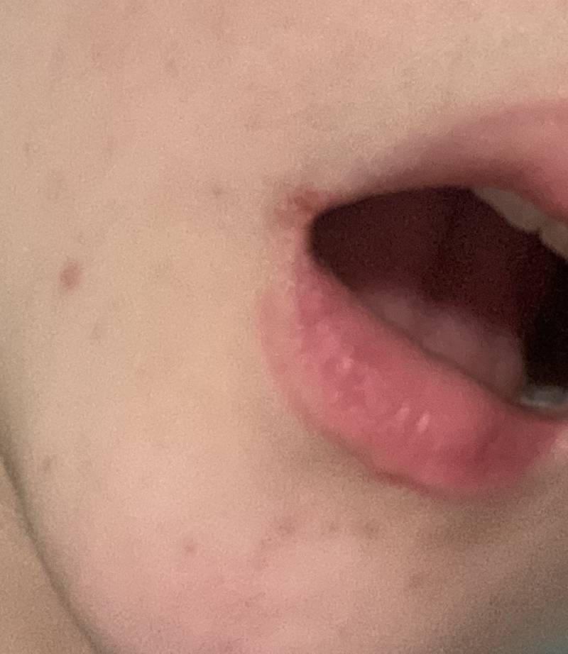 나 입술옆이 찢어졌어 ㅜㅜㅜㅜㅜㅜㅜㅠ | 인스티즈