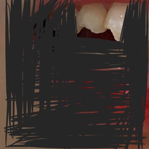 얘들아.. 앞니랑 옆니 두개 이정도 깨졌으면 얼마들까??(이사진주의) | 인스티즈