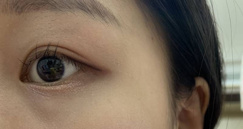 내 눈 아래 애굣살?? 부분에 주름같은거 왜 그런지 아는 사람...404040 | 인스티즈