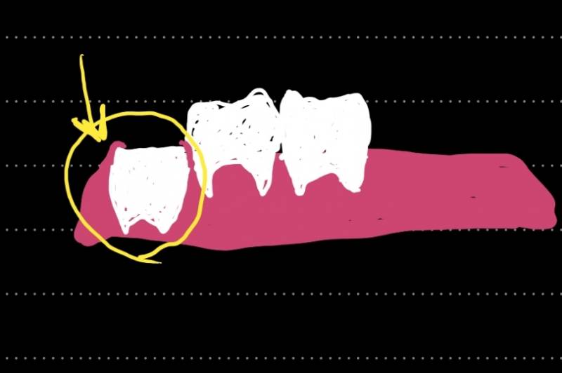 사랑니 다 안났는데 뽑는게 나을까...? | 인스티즈