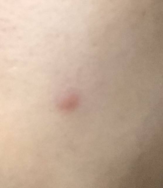 이거 모낭염일까.. | 인스티즈