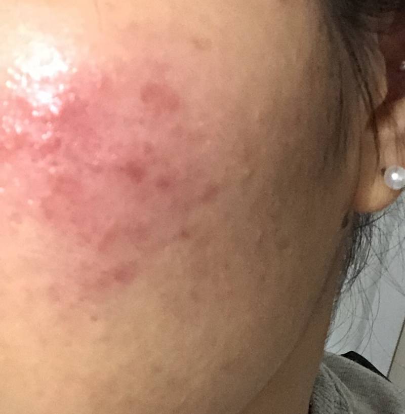 진짜 트러블 피부땜에 스트레스 받은 것보다 약 먹는 게 훨 나아... 전후 40 | 인스티즈