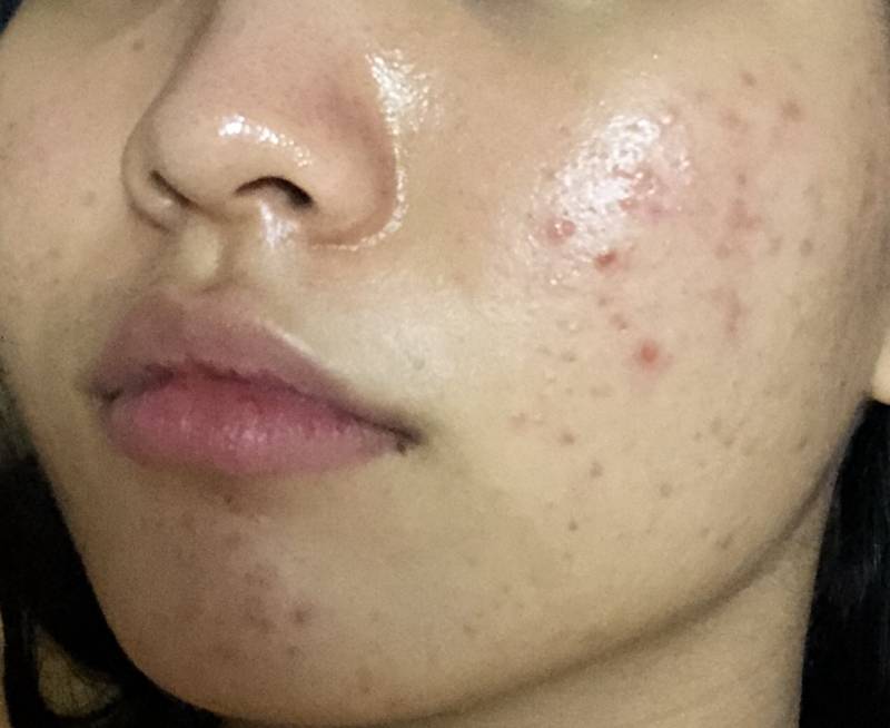 진짜 트러블 피부땜에 스트레스 받은 것보다 약 먹는 게 훨 나아... 전후 40 | 인스티즈