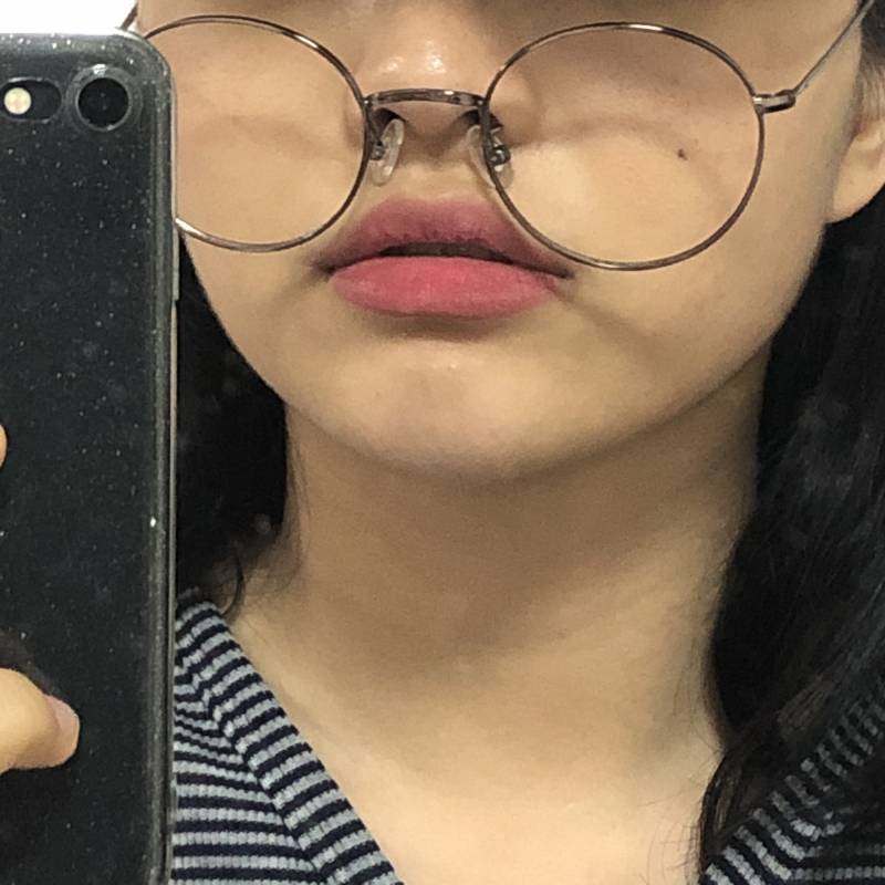 진짜 트러블 피부땜에 스트레스 받은 것보다 약 먹는 게 훨 나아... 전후 40 | 인스티즈