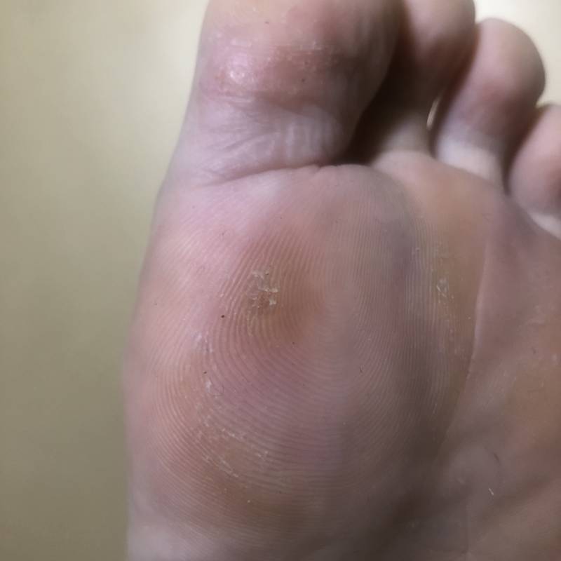 이거 티눈일까 익들아ㅜ | 인스티즈