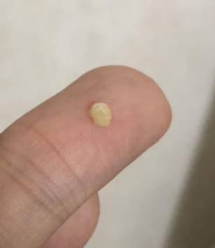 편도결석 뺐는데 핵 커..,,40(ㅎㅇㅈㅇ) | 인스티즈