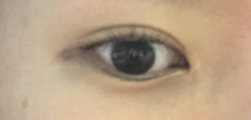 나 눈 옆에 이상한 거 생겼어.. | 인스티즈