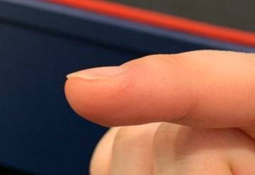 혹시 나 이거 습진이야??? | 인스티즈