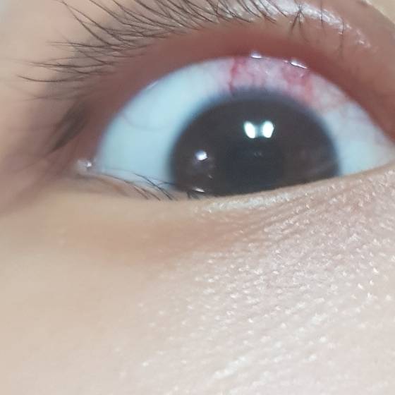 극도로혐오주의 이거 눈 충혈 다래끼때문 맞아?? | 인스티즈