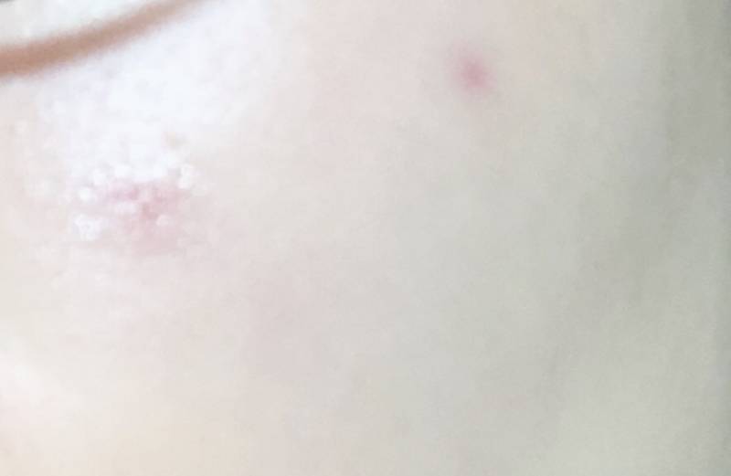 왼쪽 뾰루지 흉터 4개월 됐는데 언제 사라질까 | 인스티즈