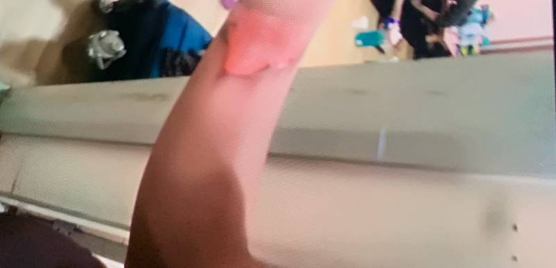 화상 입었는데 병원 가야겠지 당연히 ? (사진주의) | 인스티즈