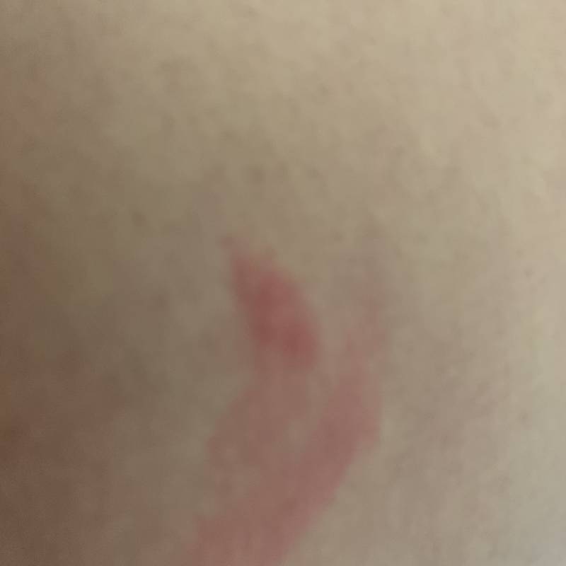 몸에 이런 빨간 반점이 생기는데 뭘까ㅠ | 인스티즈