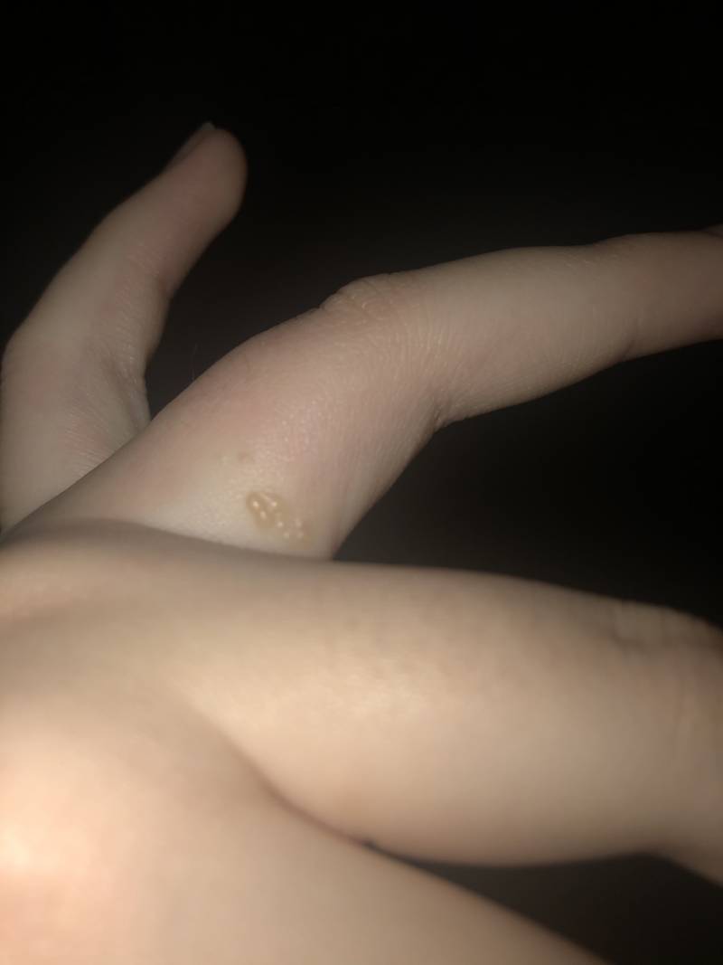 쇠알레르기 있는데 반지껴서 손가락에 뭐 생겼는데 어떻게 해야돼...?? | 인스티즈