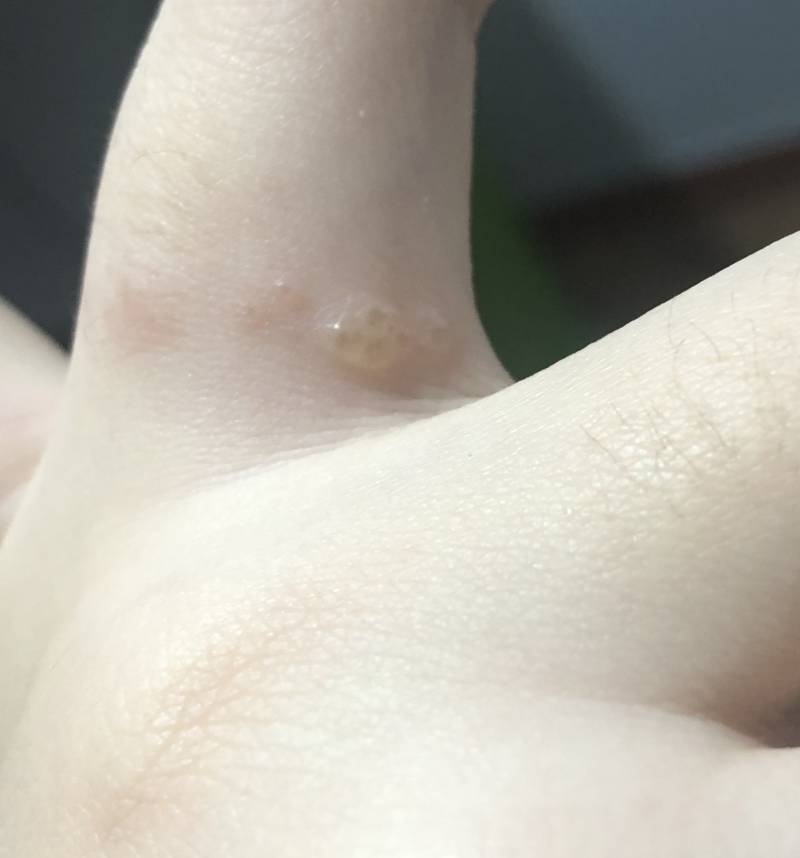 이거 물집짜는거 아플까..?? | 인스티즈