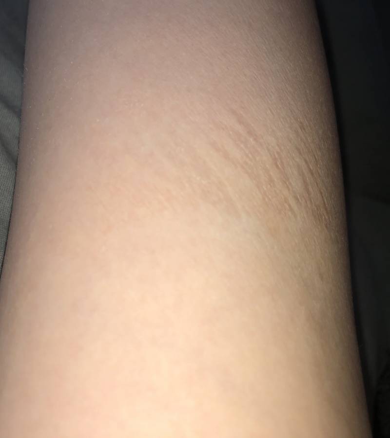 익들아 이거 튼살이야..? ㅜㅜ 한번 봐주라 | 인스티즈