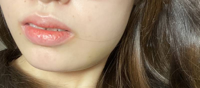 나 김쓰니 사랑니 뽑은지 4일째 치킨먹어도될까 | 인스티즈