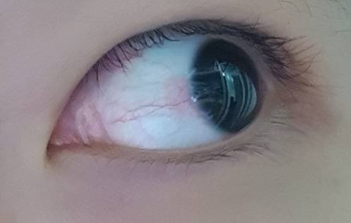 야들아 나 이거 실핏줄 터진거니..(혐오주의) | 인스티즈