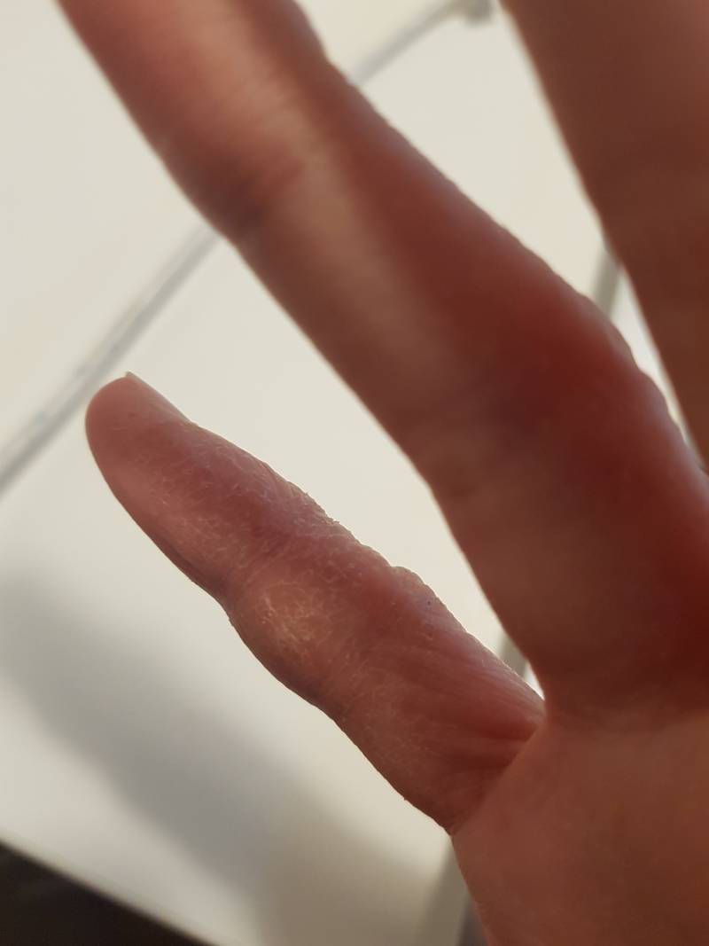 요즘 들어서 자꾸 손가락이 가려워서 긁으니까 이렇게 됐어ㅠㅠ(약간 징그러울 수 있음..?) | 인스티즈