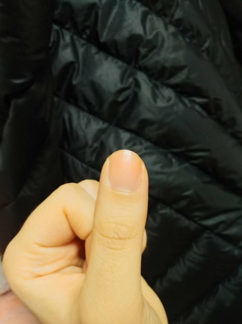 40 급해 나 네일 지웠는데 갑자기 손 끝이 화끈거리면서 빨개져 왜그런거지 | 인스티즈