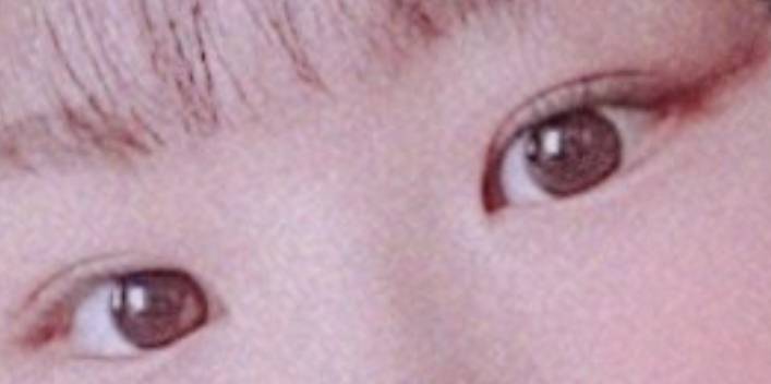 눈이 가로로 너무 짧아 무슨 수술 해야할까 | 인스티즈