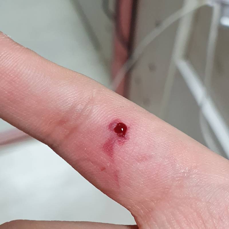 간호익 있니...? 나 피부안에 피가 고였는데 점점 부풀어 오르거든 40 | 인스티즈