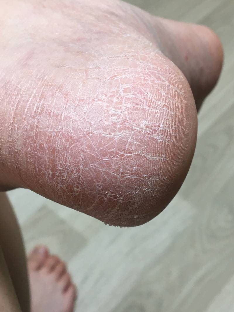 진짜 혐오주의)) 발꿈치 이런익들있어?ㅠㅠ | 인스티즈