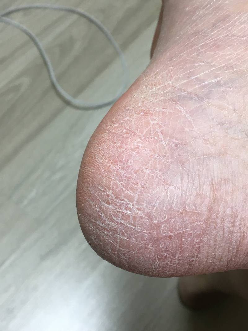 진짜 혐오주의)) 발꿈치 이런익들있어?ㅠㅠ | 인스티즈