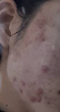 익들아 이런건 무슨 여드름이야?? 좀 혐오스러울 수도있어 ㅠㅠ | 인스티즈