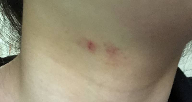 자고 일어났더니 목이 이런데 키스마크 안 같아 보이지..? | 인스티즈