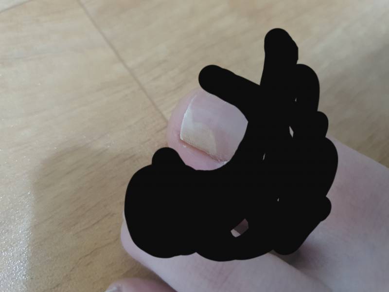 발톱 왜 이런지 아는사람? | 인스티즈