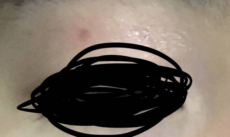 점 빼본 익들중에 나같은 빨간 흉터 남아봤던 익들 있어?ㅠㅠㅠ 이거 어떻게 해야하지 | 인스티즈