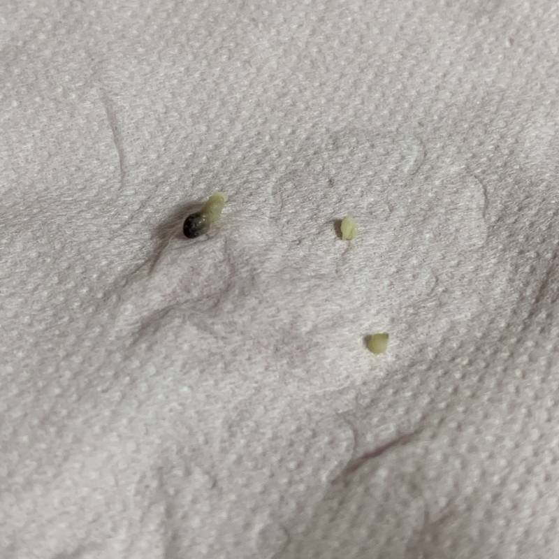 와 몸에 이런게 나올 수 있나?? 피지같은거 사진있음 못보는 사람 혐오주의ㅠㅠ!!! | 인스티즈